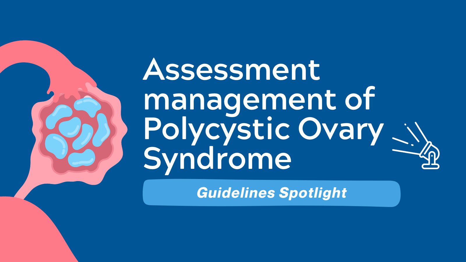 Assessment and Management of Polycystic Ovary Syndrome - Guidelines Spotlight featured image
