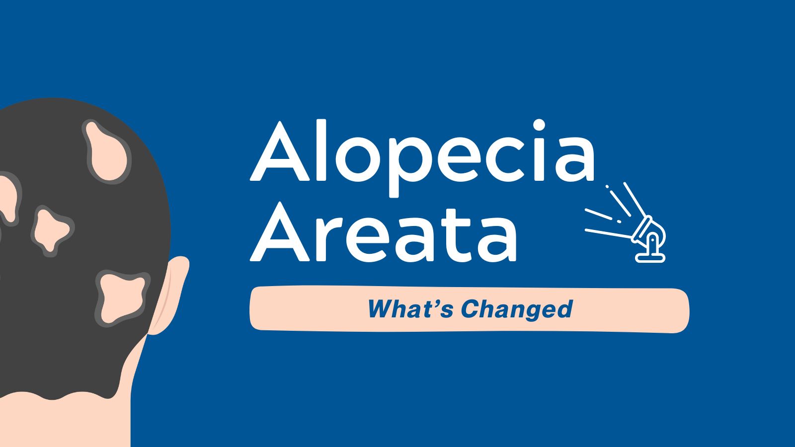 Alopecia Areata - What's Changed featured image